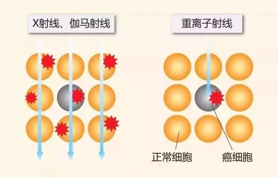 質(zhì)子重離子技術醫(yī)療險可以報銷嗎？
