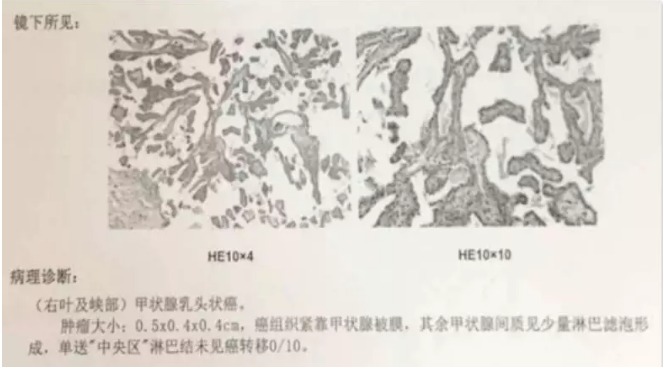 別慌，甲狀腺疾病還可以這樣投保！