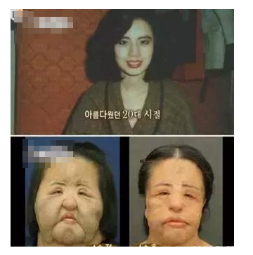 整容發(fā)生意外保險賠嗎？